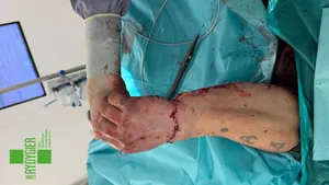 Piła odcięła mężczyźnie dłoń. Dzięki lekarzom z Krakowa stał się "mały cud"